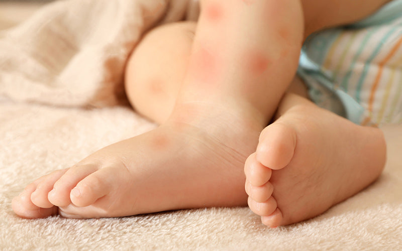 Kulit Gatal Karena Alergi Tungau Debu? Begini Cara Mengatasinya